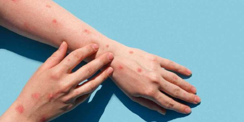 Suma México 504 casos de viruela del mono 