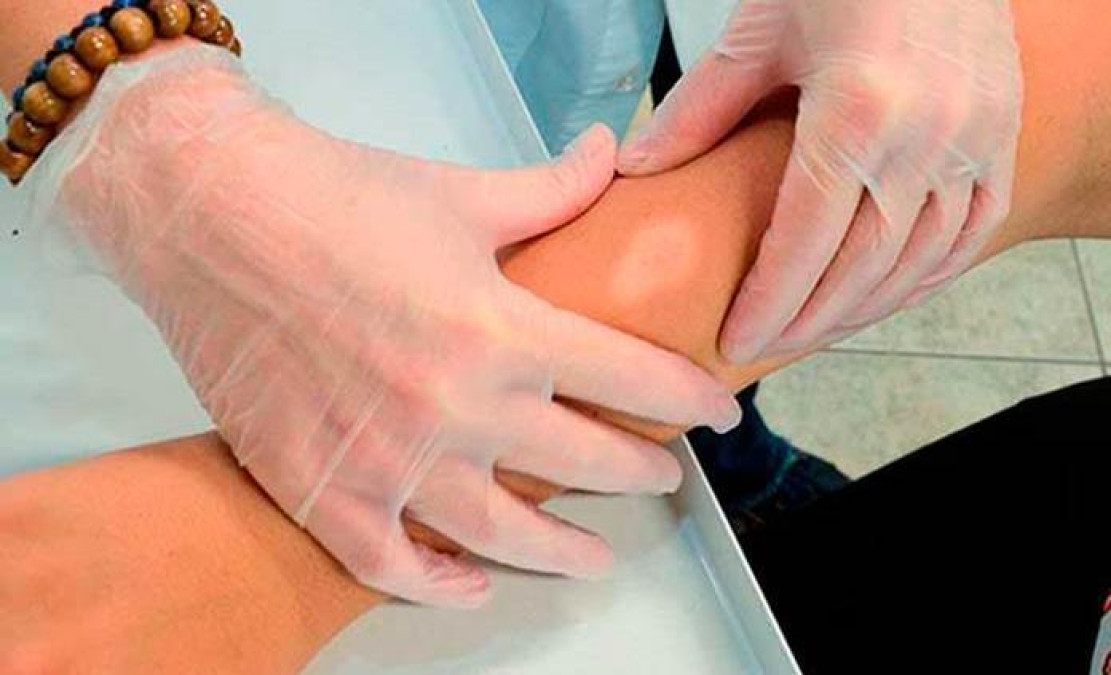 La Ssa vigila 12 municipios por casos de lepra