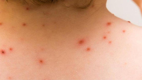 Confirma SSa 60 casos de viruela del Mono en México 