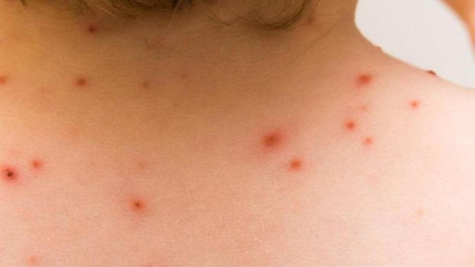 Confirma SSa 60 casos de viruela del Mono en México 