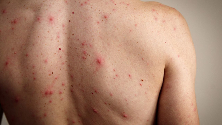 México registra 24 muertes y más de 5 mil 700 casos de sarampión, alerta Salud