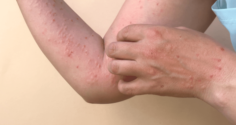 Suman mil 367 casos de Viruela del Mono en México 