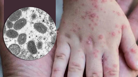 Suma México 386 casos de viruela del mono