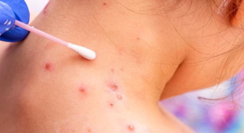 Registran más de 60 casos de viruela del mono en los últimos 14 días