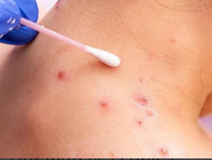 En México casos de viruela símica casi llegan a 2 mil