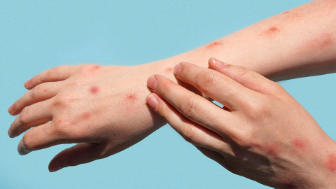 Suman 788 contagios de viruela del mono en México