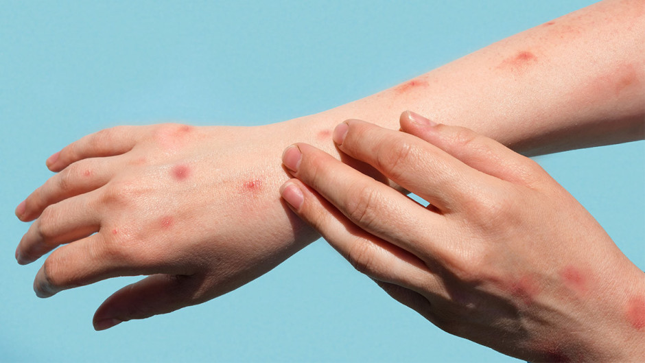 Suman 788 contagios de viruela del mono en México