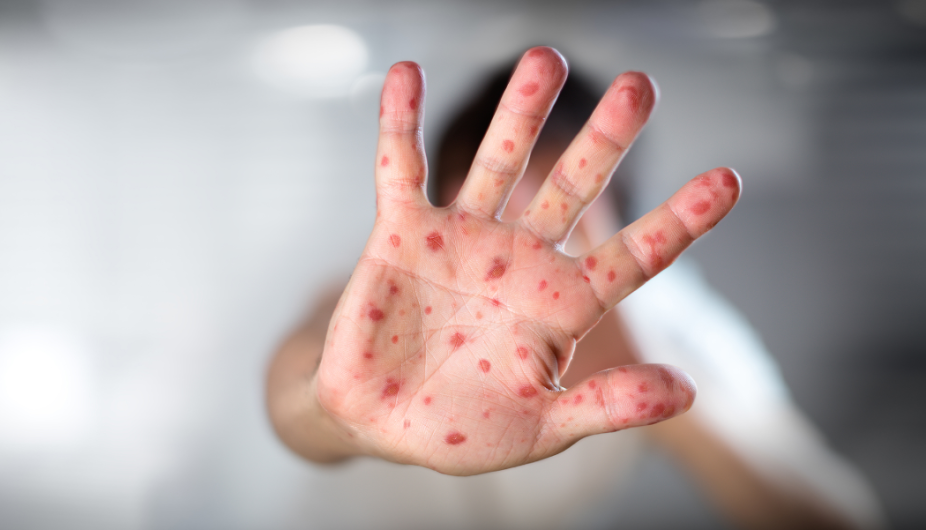 Suma México 2 mil 654 casos confirmados de viruela del mono