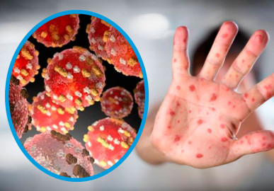 Viruela del mono, lo que debes de saber de esta enfermedad