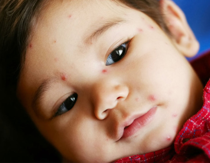 SSA anuncia aumento de contagios de varicela en Tamaulipas 