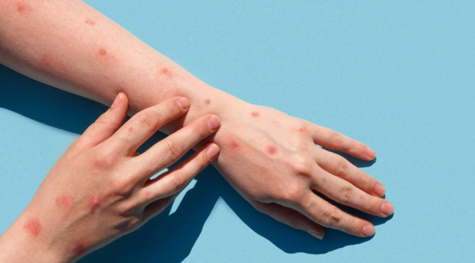 Confirma Nuevo León segundo caso de viruela del mono en la entidad