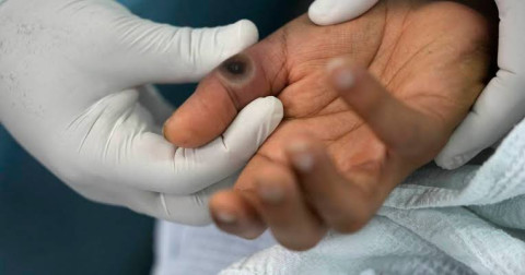 SSA confirma 51 casos de mpox en dos semanas