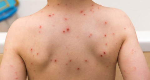 Aún sin casos, emiten alerta para detectar viruela del mono en México