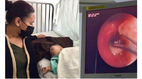 Médicos de Sonora extraen frijol crudo a niño que le impedía respirar Sonora