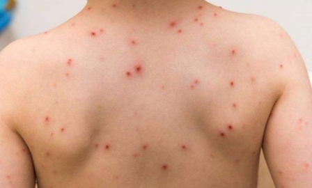 Suman mil 968 casos de viruela símica en México