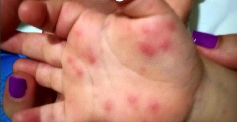 Previenen sobre virus que se presenta en menores