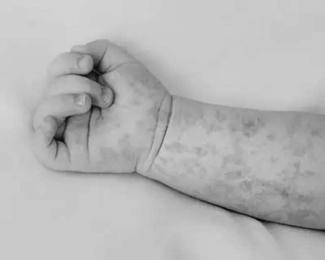 Muere bebé en Tlaxcala por complicaciones de sarampión