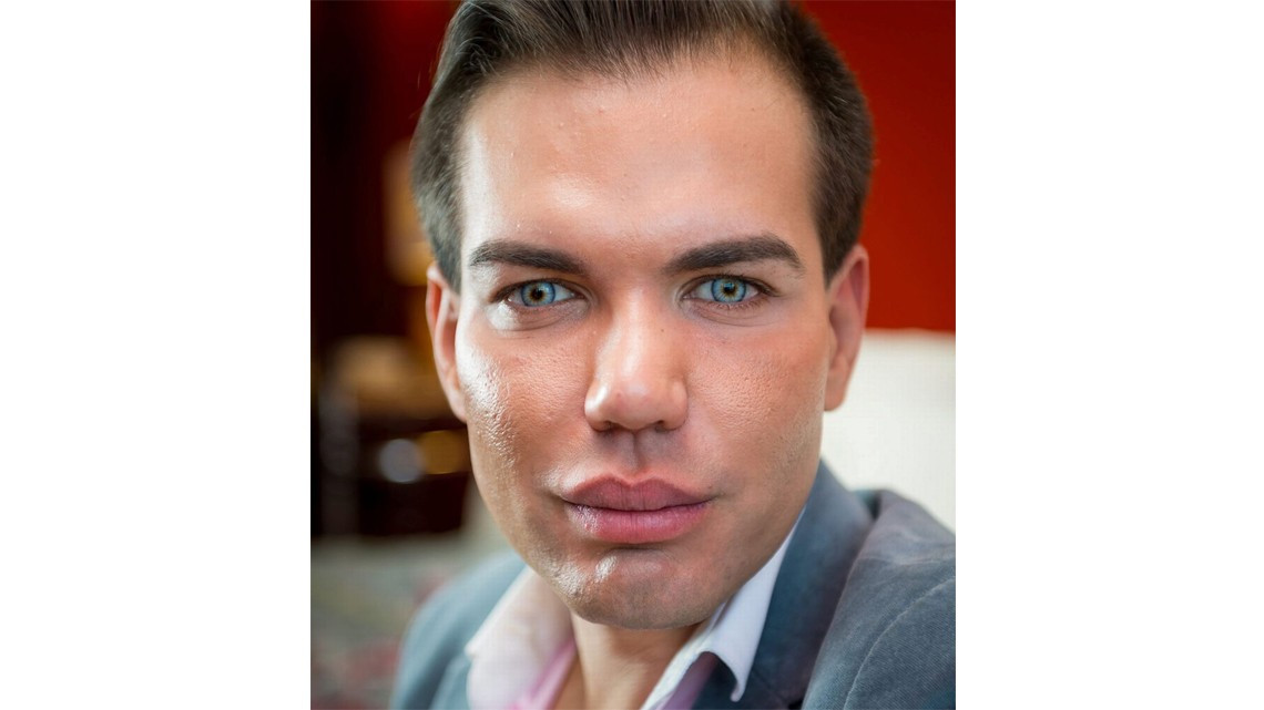 El "Ken humano" tiene complicaciones para respirar