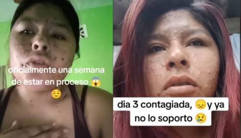 Joven confunden varicela con viruela del mono 