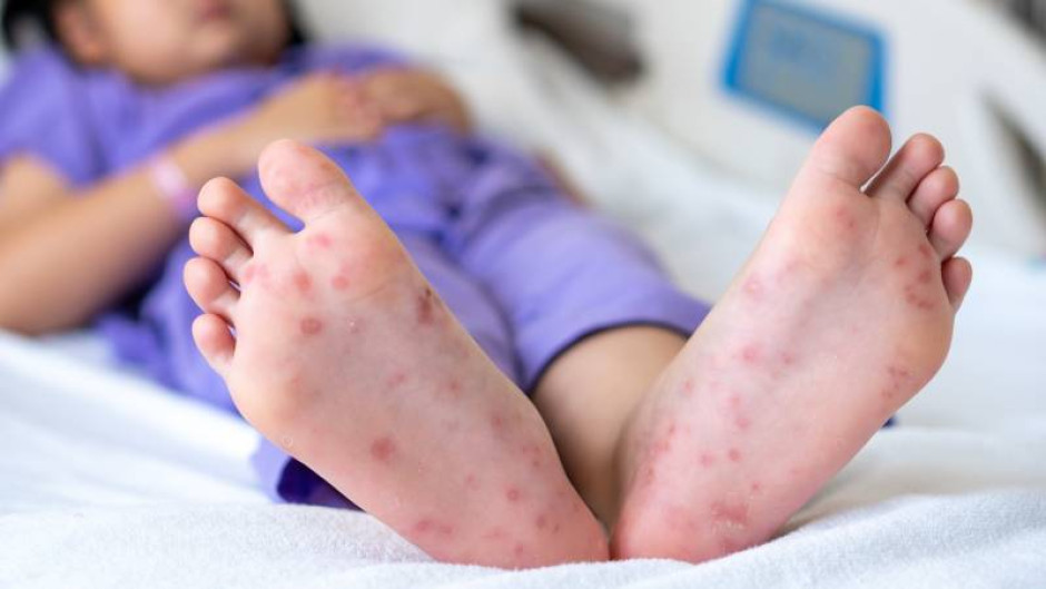 Difunde SET medidas sobre el virus boca-mano-pie entre la comunidad educativa